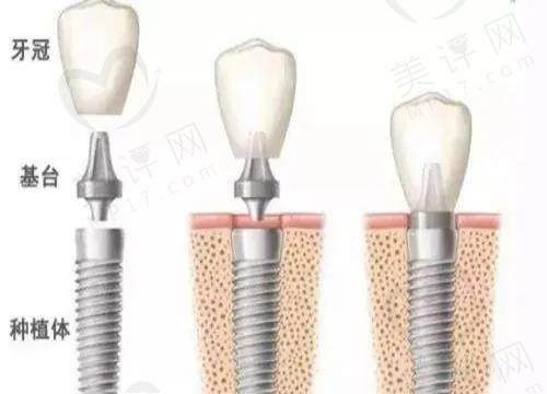 种植牙连冠是几个种植体