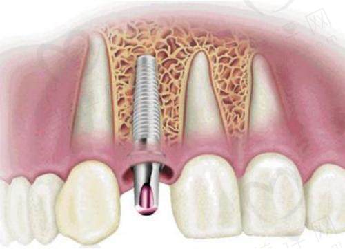 种植牙做连冠牙好还是单个好