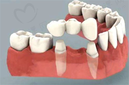 牙齿固定桥修复还是种植好