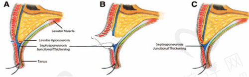 SAJT双眼皮固定技术优点