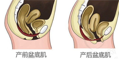 产后盆底肌修复的良佳时间和费用是