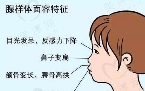 孩子腺样体面容可以矫正吗