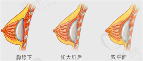 假体隆胸手术的原理和植入方式