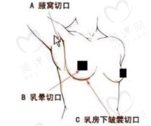 假体隆胸手术切口