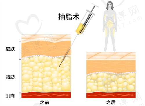 超美塑不仅仅是减脂，是结合脂肪做抗衰