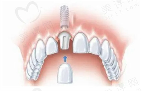 泉州医院牙科种植牙价格