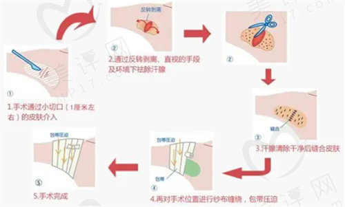 腋臭手术需要多钱？