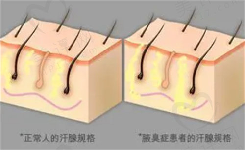 激光治疗狐臭价格