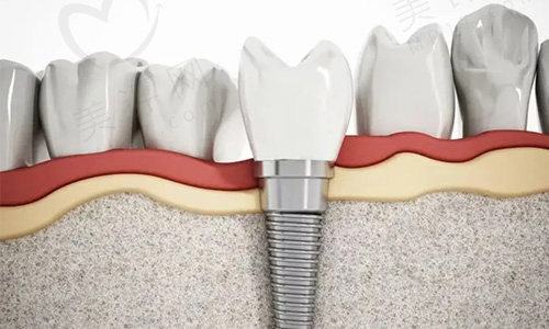 种植牙的好处与危害