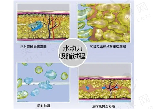 水动力吸脂过程