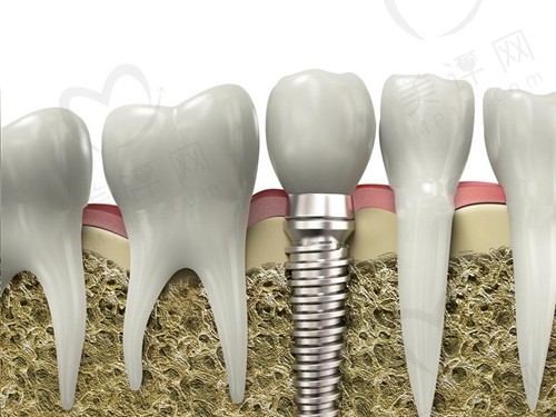 种植牙与传统义齿的区别