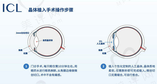 重庆普瑞眼科医院做近视手术的技术不错