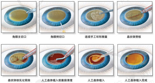 白内障超声乳化+人工晶体植入术步骤