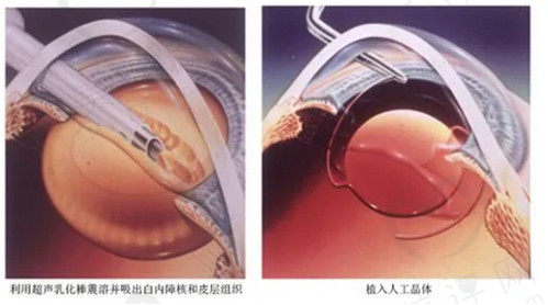 超声乳化白内障手术的优点