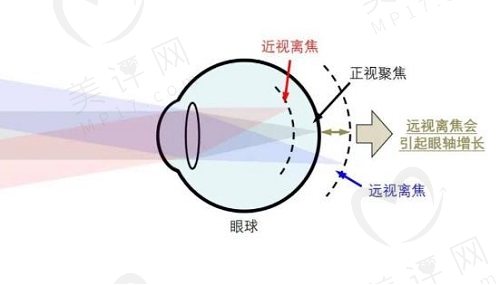 MRT多光谱屈光地形图