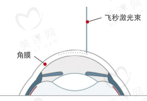 绿飞秒的优缺点