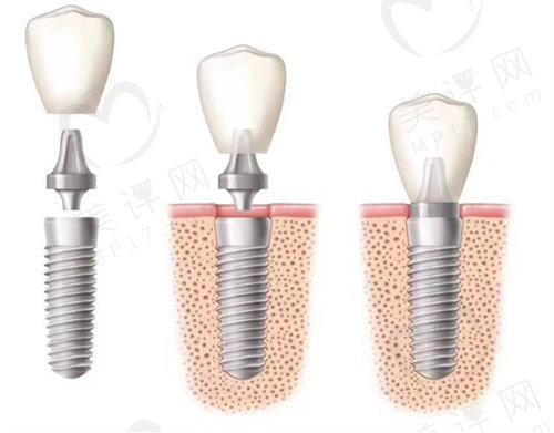 岳阳阳光口腔医院种植牙价格表