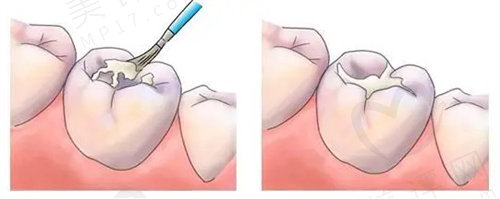 绍兴柯桥德维口腔医院补牙怎么样