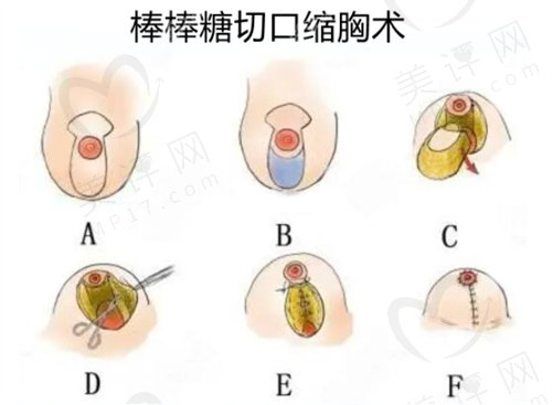 花苞精Diao术和棒棒糖法缩胸区别是什么？