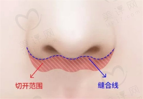 卢九宁做人中缩短术价格