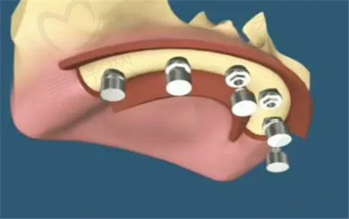 北京美莱口腔医院全口种植牙价格