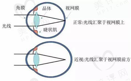 合肥东南眼科医院近视眼手术好