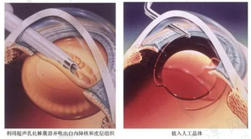 北京民众眼科朱思泉医生做的白内障手术技术高超