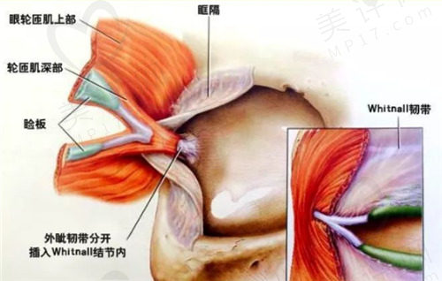 上海伯思立整形做双眼皮修复技术高