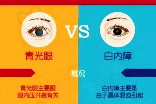 白内障合并青光眼有哪些症状