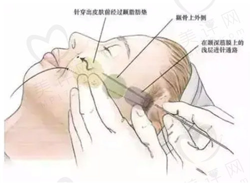 pst面部提升手术步骤