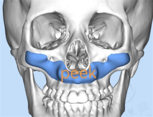 上海做peek鼻基底的医院