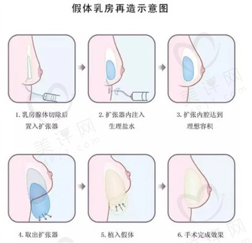 假体乳房再造示意图