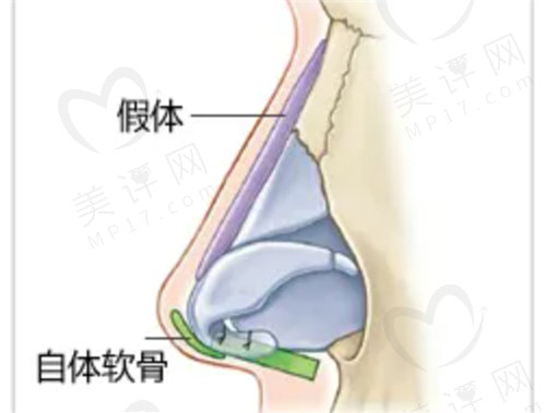 徐佳明医生的隆鼻特点