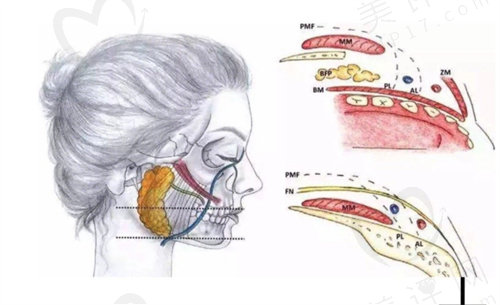 去颊脂垫的后遗症