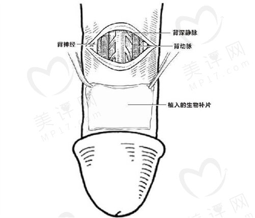 生物补片增粗手术后遗症有哪些？