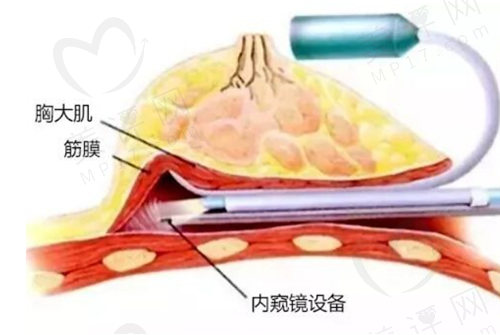 南京美莱丰胸技术高