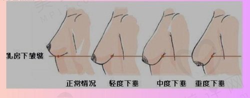 非手术乳房下垂矫正法