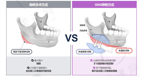 韩国GNG医院 下颌角整形手术