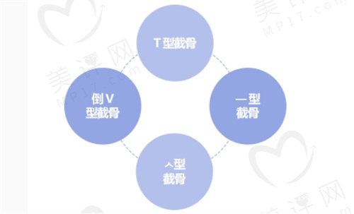 韩国GNG医院 下巴整形手术