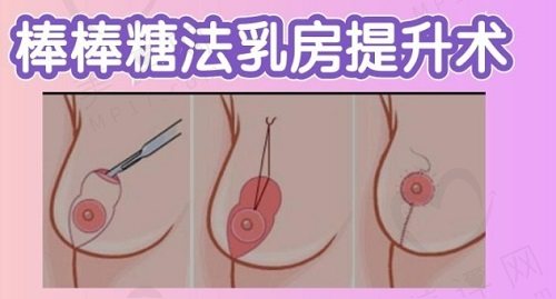 复合型乳房整形术