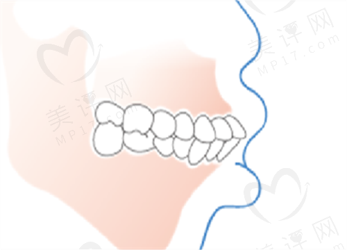 牙齿咬合错位牙齿矫正有用吗