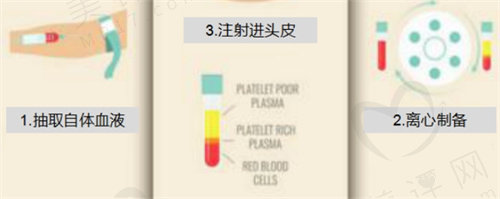 cgf治疗脱发是什么