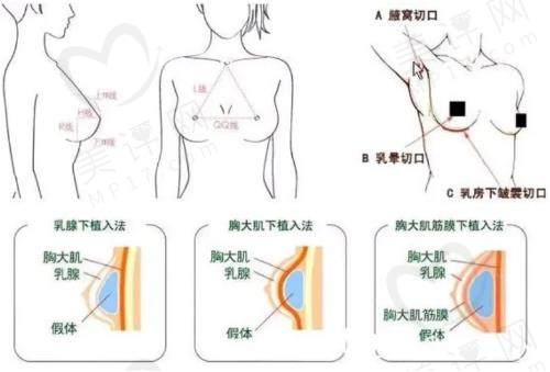 李高峰隆胸手术做得怎么样