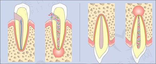 根尖周炎是什么