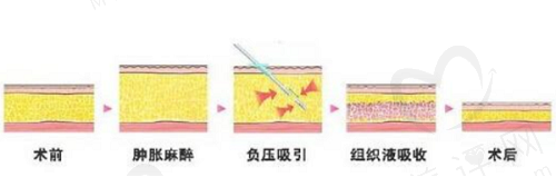 长沙艺星欧阳鑫抽脂技术优势