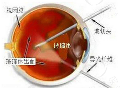 眼睛玻切是什么意思