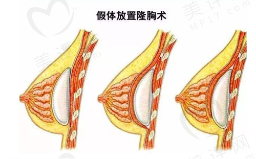 王谊医生做假体隆胸手术好