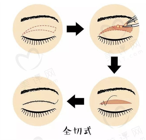 宁波全切双眼皮价格