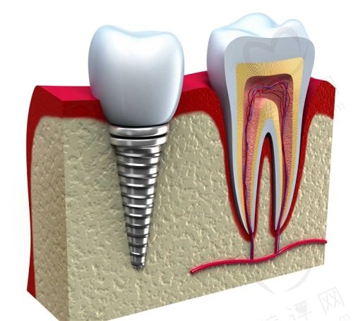 重庆种植牙多少钱一颗2024价格表