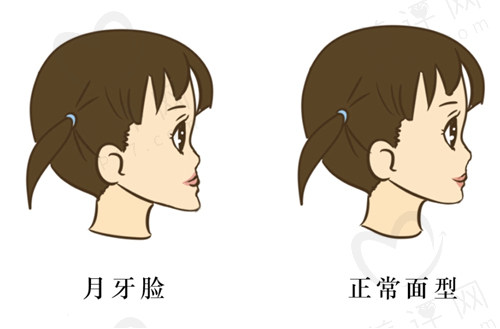 正颌手术不适合哪些人做？